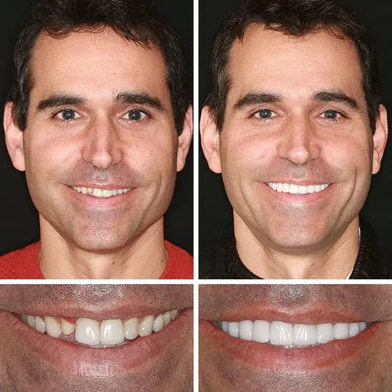 ⏰Ends Today: 50% OFF! Custom-Fit — Designed for Comfort and a Natural-Looking Smile